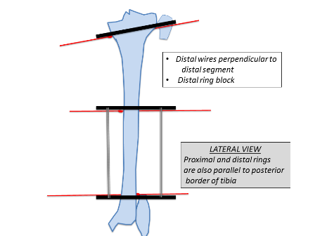 Fixation of ring fixator to proximal tibia. (a) Transverse wire
